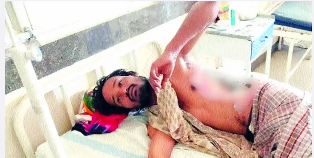 उज्जैन में सनसनीखेज वारदात: युवक पर तेजाब फेंकने का आरोप, पुलिस ने बताया झूठा